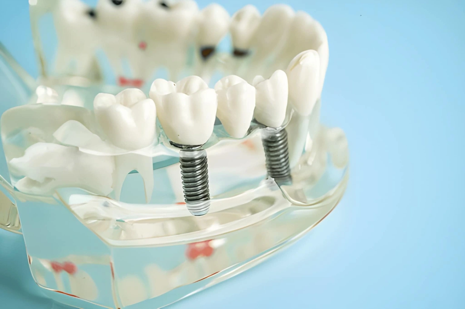 dental implants near you