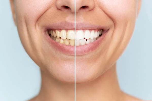 teeth whitening near you