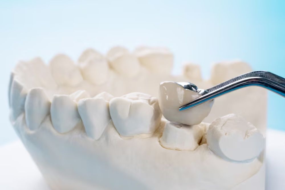 beyond aesthetics understanding the functional benefits of dental crowns in restorative dentistry