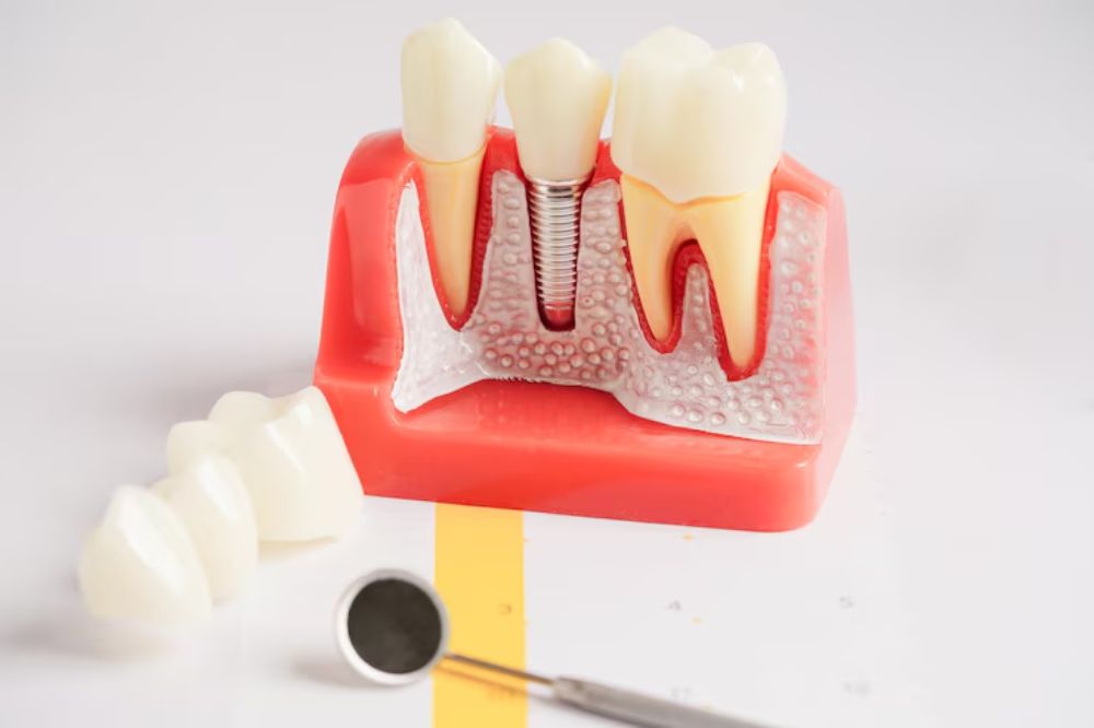 is a temporary tooth possible during the dental implant process