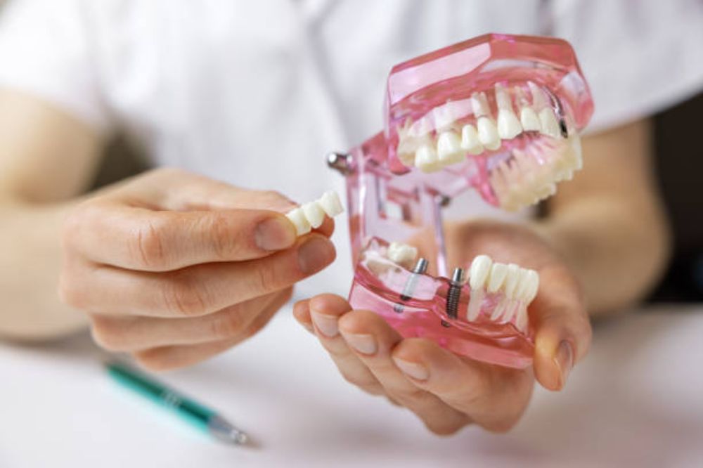 how often should i replace my dental bridge